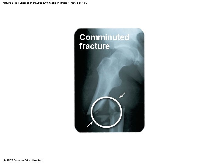 Figure 6 -16 Types of Fractures and Steps in Repair (Part 9 of 17).