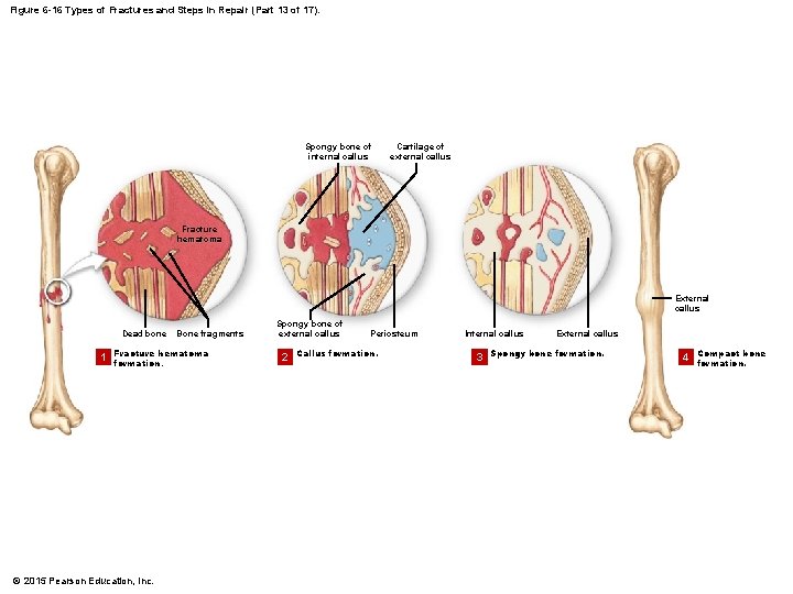 Figure 6 -16 Types of Fractures and Steps in Repair (Part 13 of 17).