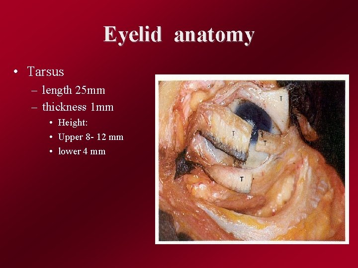 Eyelid anatomy • Tarsus – length 25 mm – thickness 1 mm • Height: