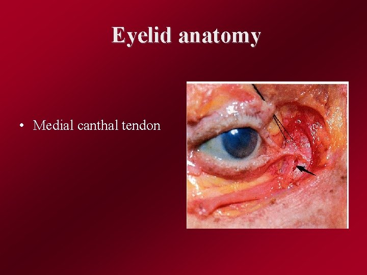 Eyelid anatomy • Medial canthal tendon 