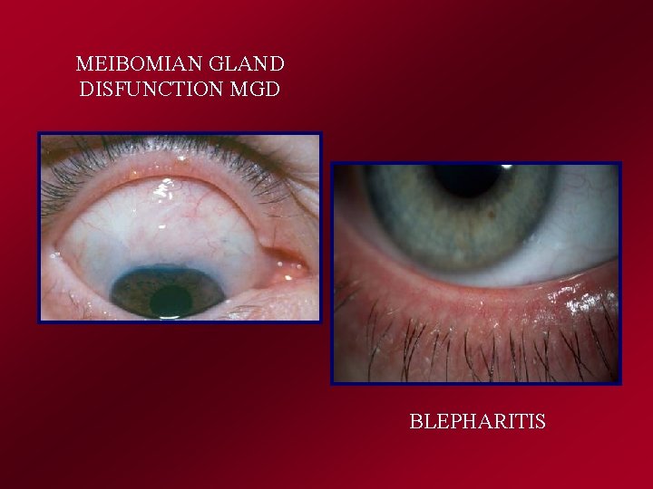 MEIBOMIAN GLAND DISFUNCTION MGD BLEPHARITIS 