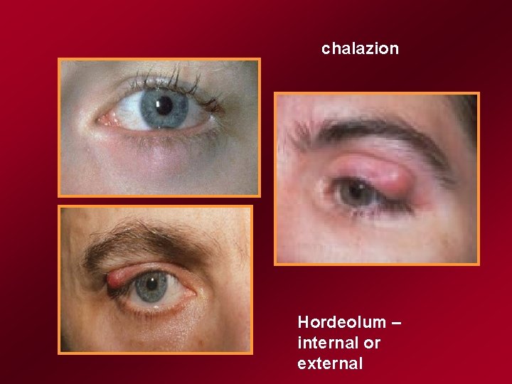 chalazion Hordeolum – internal or external 