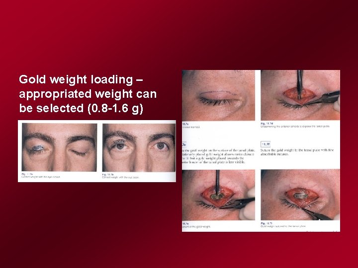 Gold weight loading – appropriated weight can be selected (0. 8 -1. 6 g)