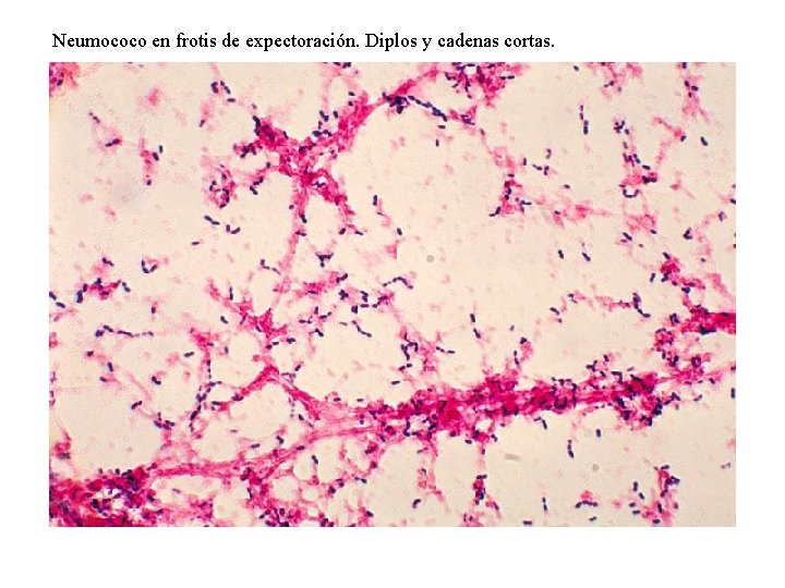 Neumococo en frotis de expectoración. Diplos y cadenas cortas. 