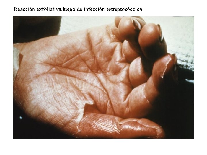 Reacción exfoliativa luego de infección estreptocóccica 