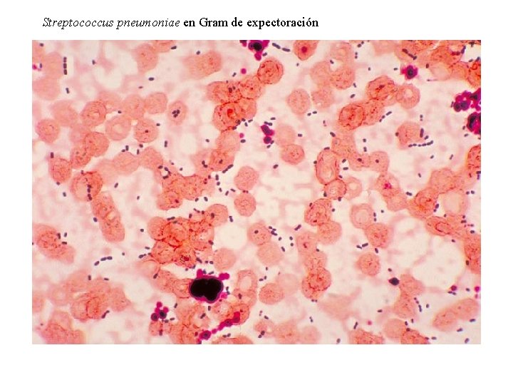 Streptococcus pneumoniae en Gram de expectoración 