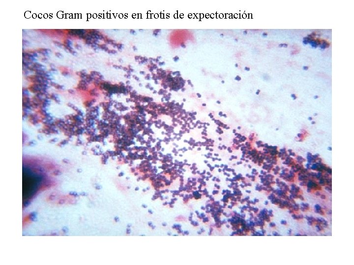 Cocos Gram positivos en frotis de expectoración 