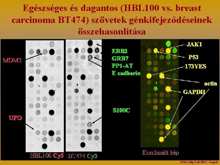 Egészséges és dagantos (HBL 100 vs. breast carcinoma BT 474) szövetek génkifejeződéseinek összehasonlítása DNA-chip