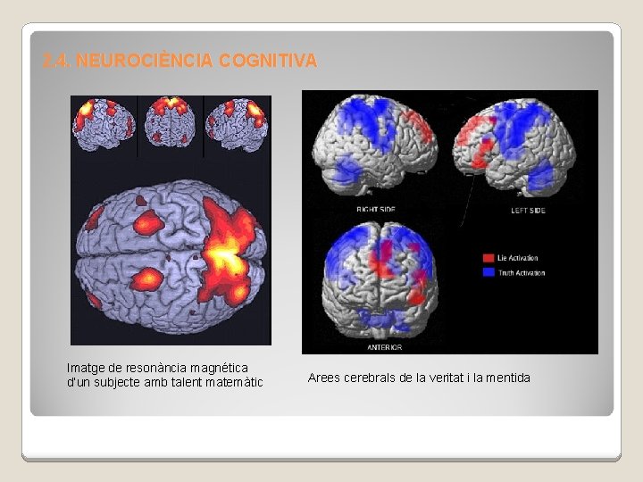 2. 4. NEUROCIÈNCIA COGNITIVA Imatge de resonància magnética d’un subjecte amb talent matemàtic Arees