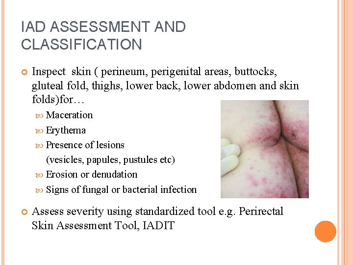 IAD ASSESSMENT AND CLASSIFICATION Inspect skin ( perineum, perigenital areas, buttocks, gluteal fold, thighs,