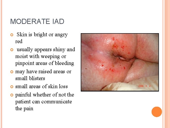 MODERATE IAD Skin is bright or angry red usually appears shiny and moist with