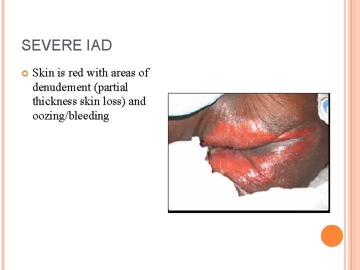 SEVERE IAD Skin is red with areas of denudement (partial thickness skin loss) and