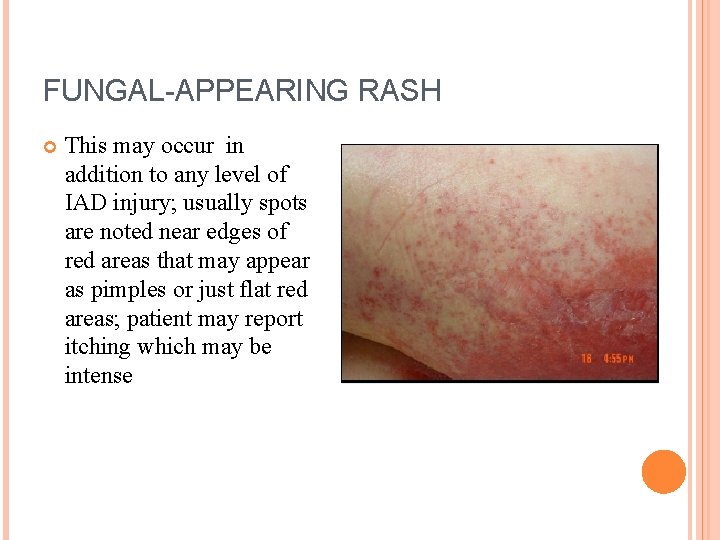 FUNGAL-APPEARING RASH This may occur in addition to any level of IAD injury; usually