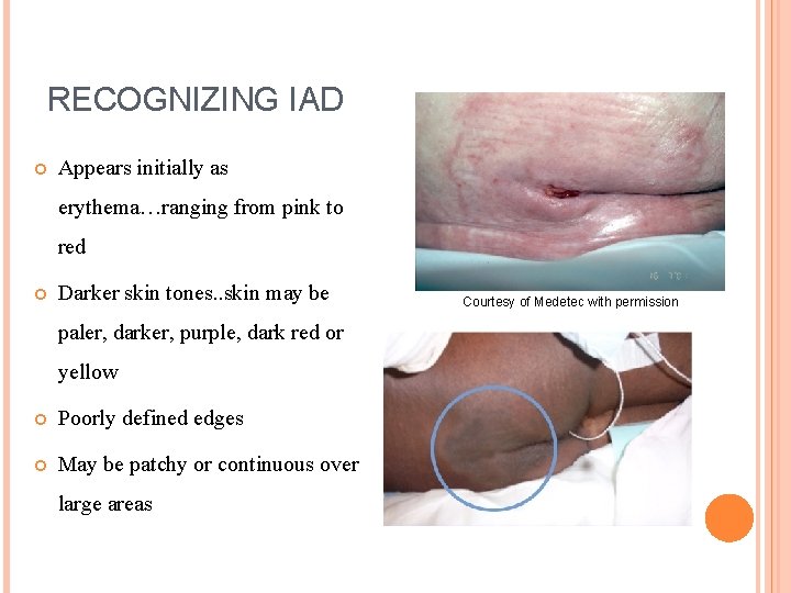 RECOGNIZING IAD Appears initially as erythema…ranging from pink to red Darker skin tones. .