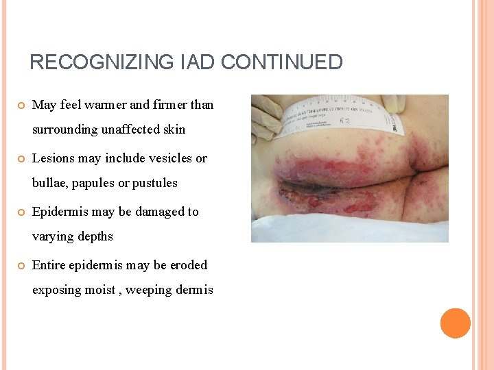RECOGNIZING IAD CONTINUED May feel warmer and firmer than surrounding unaffected skin Lesions may