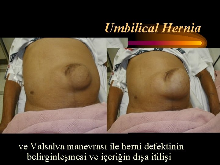 Umbilical Hernia ve Valsalva manevrası ile herni defektinin belirginleşmesi ve içeriğin dışa itilişi 