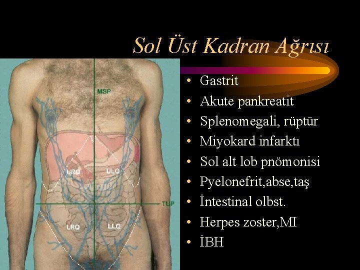 Sol Üst Kadran Ağrısı • • • Gastrit Akute pankreatit Splenomegali, rüptür Miyokard infarktı