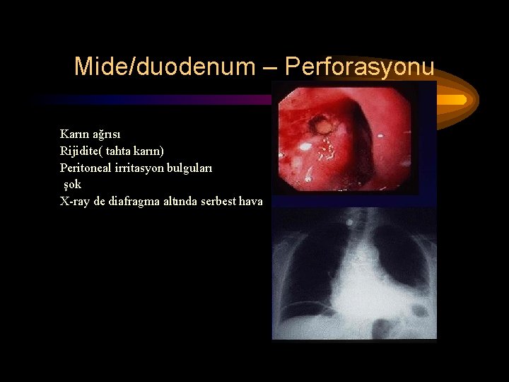 Mide/duodenum – Perforasyonu Karın ağrısı Rijidite( tahta karın) Peritoneal irritasyon bulguları şok X-ray de