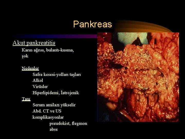 Pankreas Akut pankreatitis Karın ağrısı, bulantı-kusma, şok Nedenler Safra kesesi-yolları taşları Alkol Virüsler Hiperlipidemi,