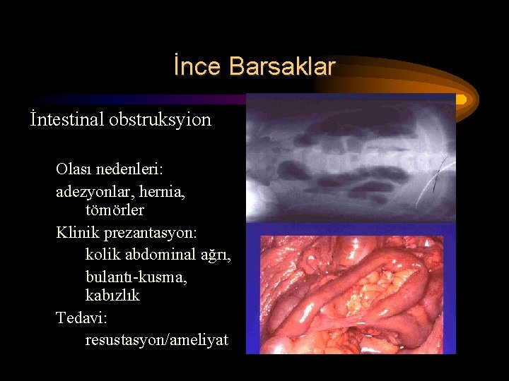 İnce Barsaklar İntestinal obstruksyion Olası nedenleri: adezyonlar, hernia, tömörler Klinik prezantasyon: kolik abdominal ağrı, İnce Barsaklar İntestinal obstruksyion Olası nedenleri: adezyonlar, hernia, tömörler Klinik prezantasyon: kolik abdominal ağrı,