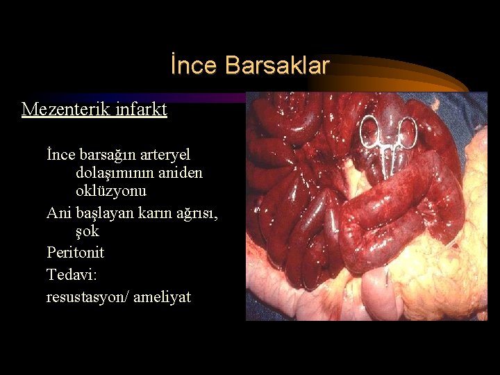 İnce Barsaklar Mezenterik infarkt İnce barsağın arteryel dolaşımının aniden oklüzyonu Ani başlayan karın ağrısı, İnce Barsaklar Mezenterik infarkt İnce barsağın arteryel dolaşımının aniden oklüzyonu Ani başlayan karın ağrısı,