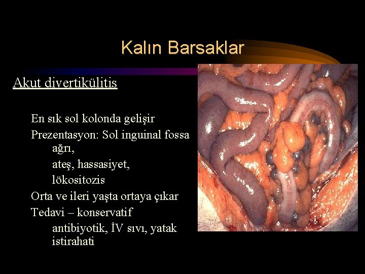 Kalın Barsaklar Akut divertikülitis En sık sol kolonda gelişir Prezentasyon: Sol inguinal fossa ağrı,