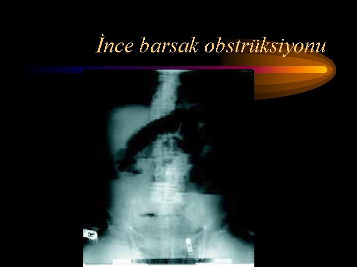 İnce barsak obstrüksiyonu İnce barsak obstrüksiyonu