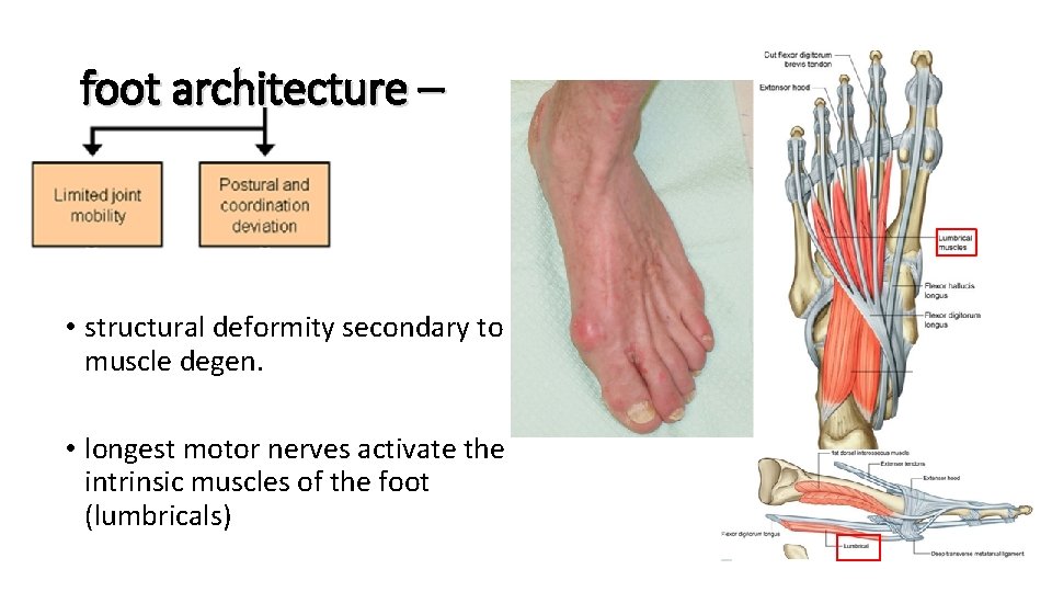 foot architecture – • structural deformity secondary to muscle degen. • longest motor nerves