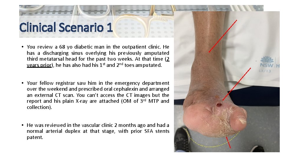 Clinical Scenario 1 • You review a 68 yo diabetic man in the outpatient