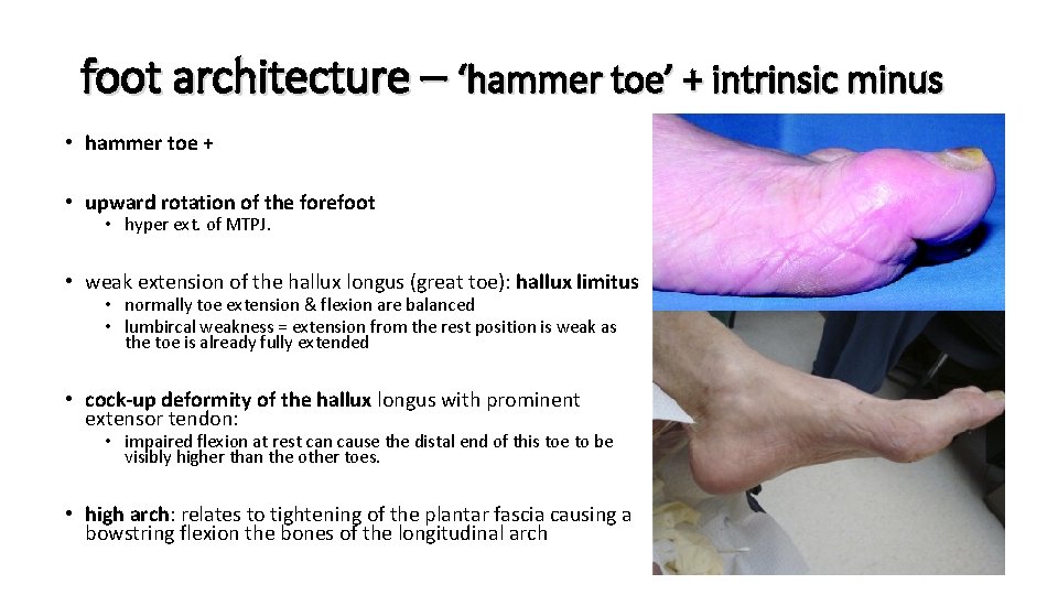 foot architecture – ‘hammer toe’ + intrinsic minus • hammer toe + • upward