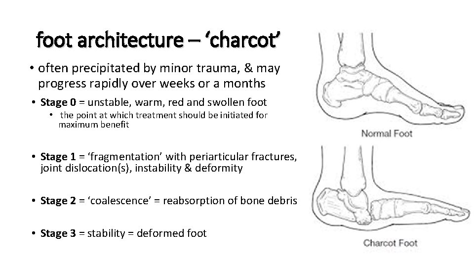 foot architecture – ‘charcot’ • often precipitated by minor trauma, & may progress rapidly