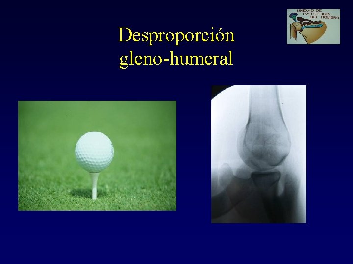 Desproporción gleno-humeral 