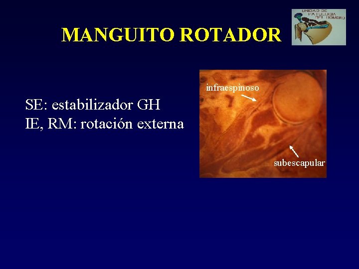 MANGUITO ROTADOR infraespinoso SE: estabilizador GH IE, RM: rotación externa subescapular 