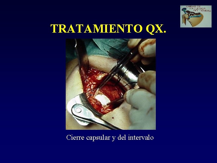 TRATAMIENTO QX. Cierre capsular y del intervalo 