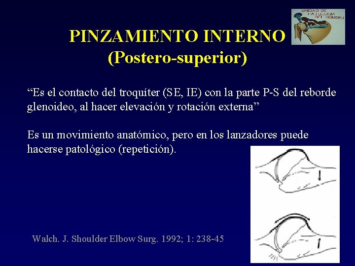 PINZAMIENTO INTERNO (Postero-superior) “Es el contacto del troquíter (SE, IE) con la parte P-S