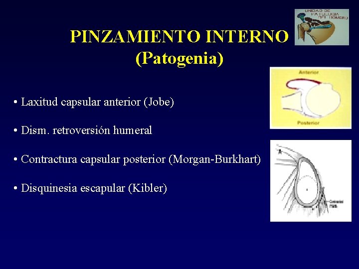 PINZAMIENTO INTERNO (Patogenia) • Laxitud capsular anterior (Jobe) • Dism. retroversión humeral • Contractura