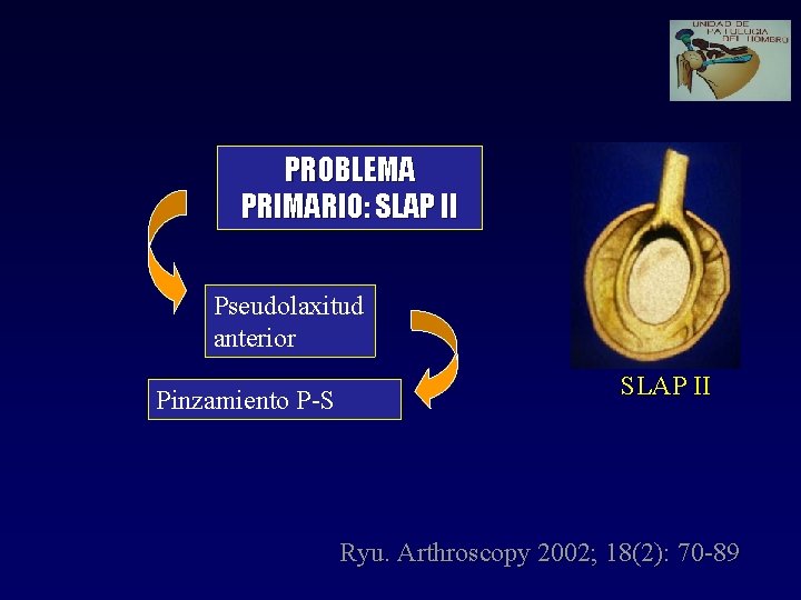 PROBLEMA PRIMARIO: SLAP II Pseudolaxitud anterior Pinzamiento P-S SLAP II Ryu. Arthroscopy 2002; 18(2):