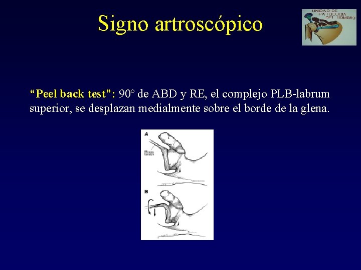 Signo artroscópico “Peel back test”: 90º de ABD y RE, el complejo PLB-labrum superior,
