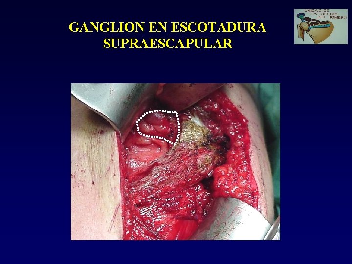 GANGLION EN ESCOTADURA SUPRAESCAPULAR 