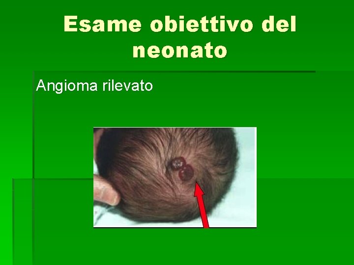 Esame obiettivo del neonato Angioma rilevato 