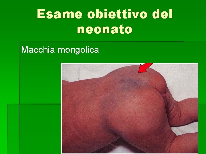 Esame obiettivo del neonato Macchia mongolica 
