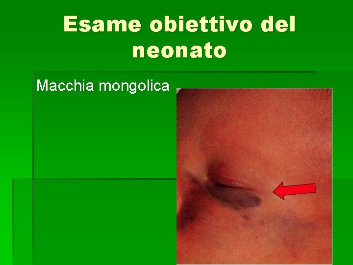 Esame obiettivo del neonato Macchia mongolica 