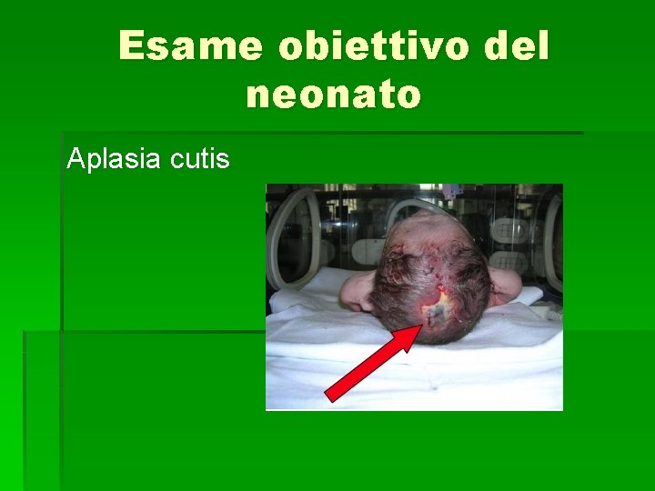 Esame obiettivo del neonato Aplasia cutis 