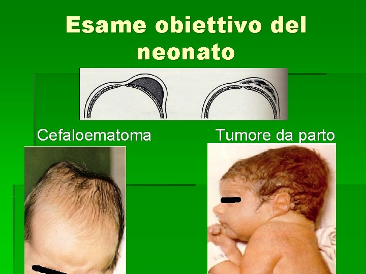 Esame obiettivo del neonato Cefaloematoma Tumore da parto 