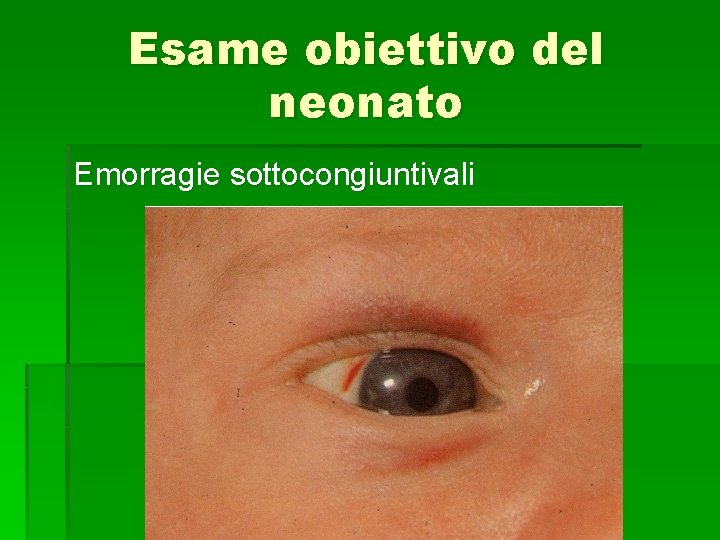 Esame obiettivo del neonato Emorragie sottocongiuntivali 