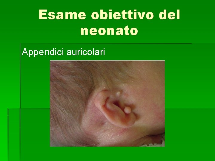 Esame obiettivo del neonato Appendici auricolari 