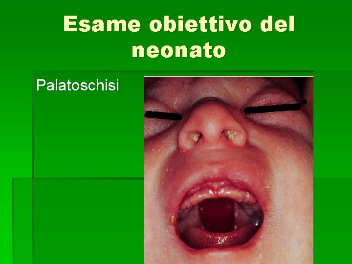 Esame obiettivo del neonato Palatoschisi 