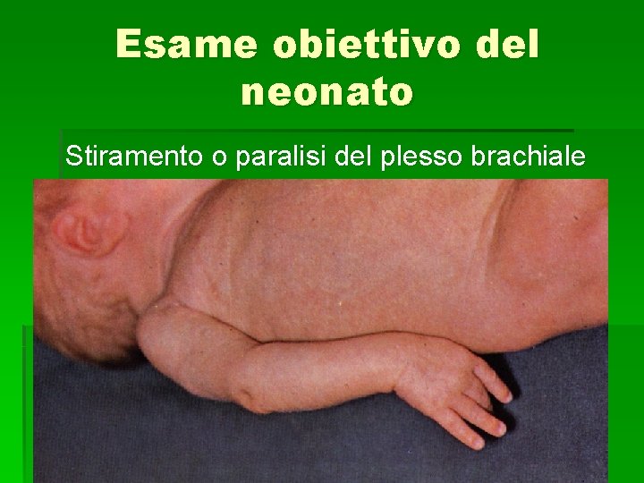 Esame obiettivo del neonato Stiramento o paralisi del plesso brachiale 