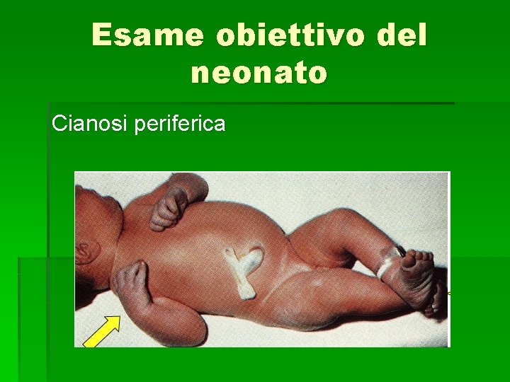 Esame obiettivo del neonato Cianosi periferica 