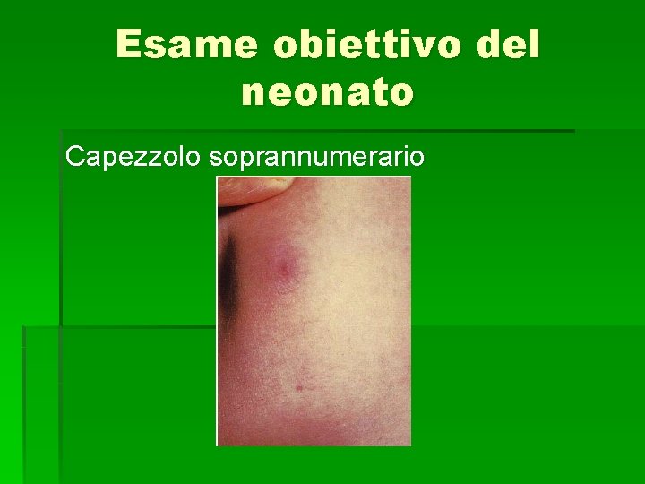 Esame obiettivo del neonato Capezzolo soprannumerario 